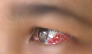 Pendarahan Pada Mata – Subconjunctival Hemorrhage